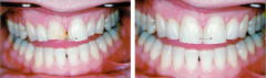 欠けたり変色した歯の修復のビフォーアフター
